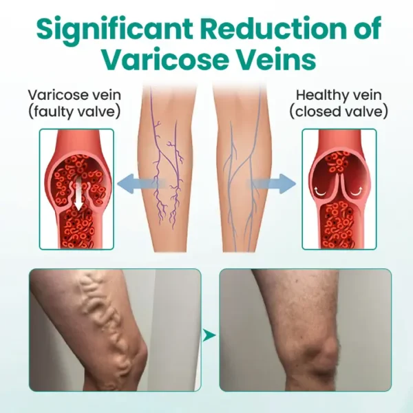 Timilk® LegRenew Varicose Veins Patch