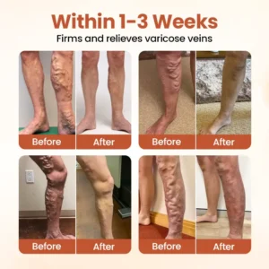 Timilk® VeinTarget Microneedle Patch