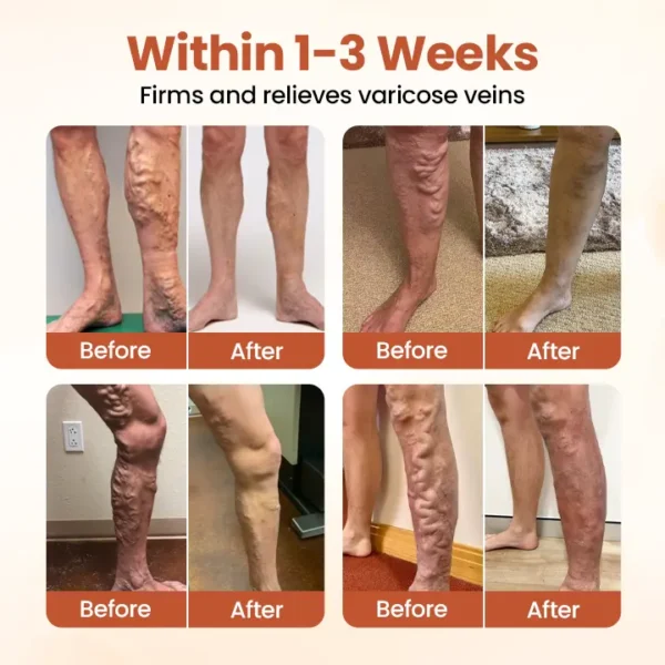Timilk® VeinTarget Microneedle Patch