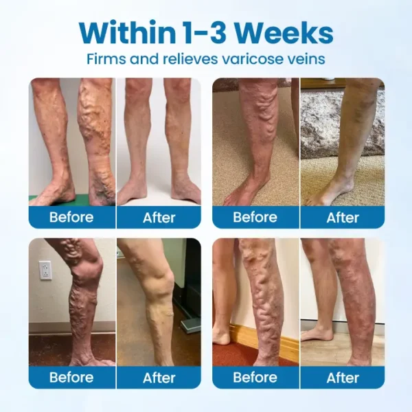 Timilk® VeinGuard Herbal Spray - Clinically Proven to Eliminate Varicose Veins in Just 7 Days!