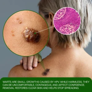 Timilk® ClinixClear Wart Remover Patch (A)