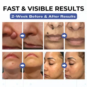 Timilk® VanishPro Skin Spot Removal Cream 🇬🇧 XH-VanishPro-upsell