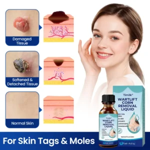 Timilk® WartLift Corn Removal Liquid