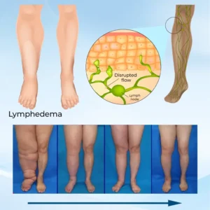 ✅ Official Store: Timilk® LymphoEase Magnesium PCA Roll-On Relief Cream 🔥 FDA Certified (Clinically Proven Relief for Lymphedema, Leg Swelling & Poor Circulation 🩺)